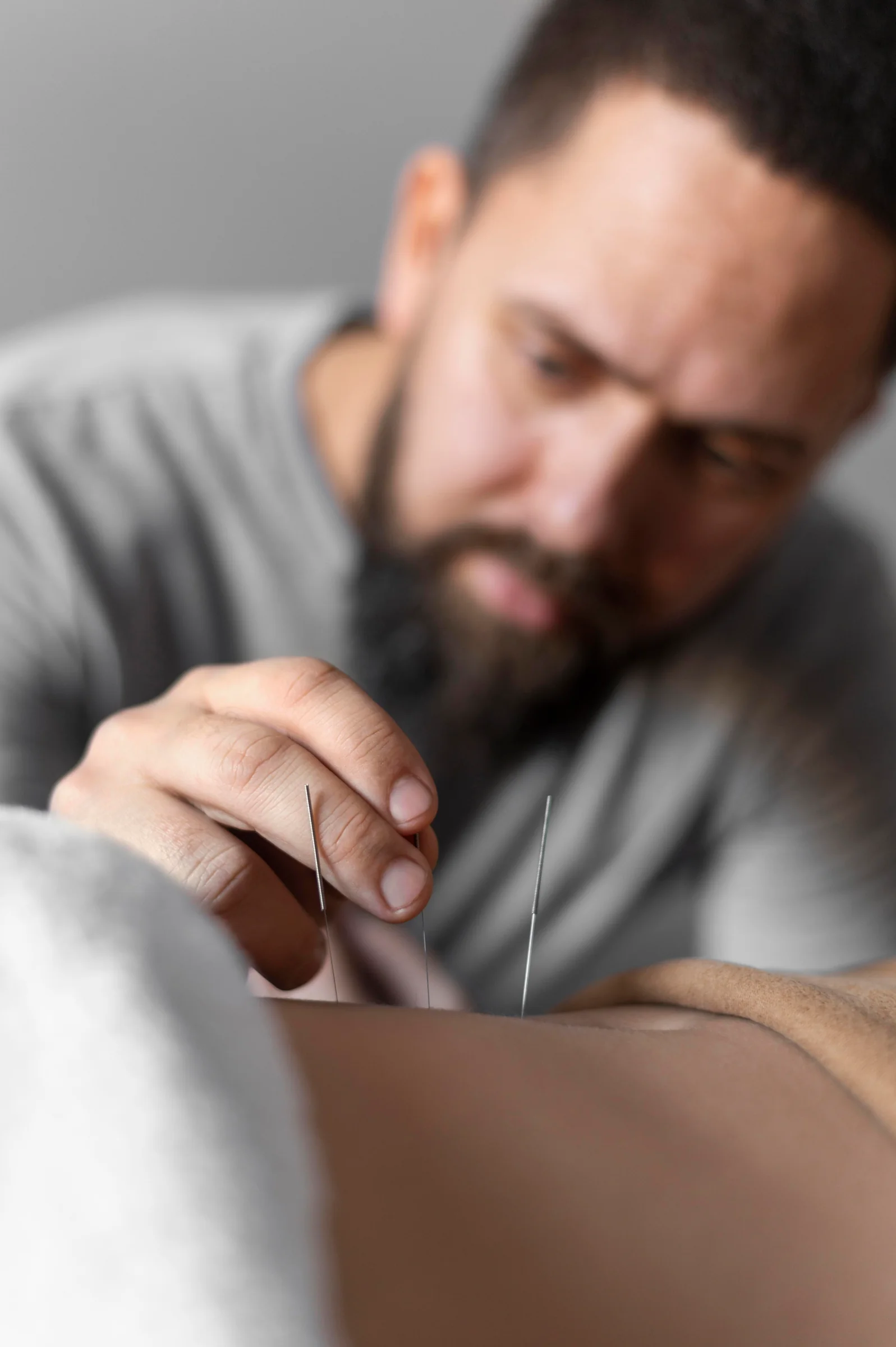 Benefits of Acupuncture