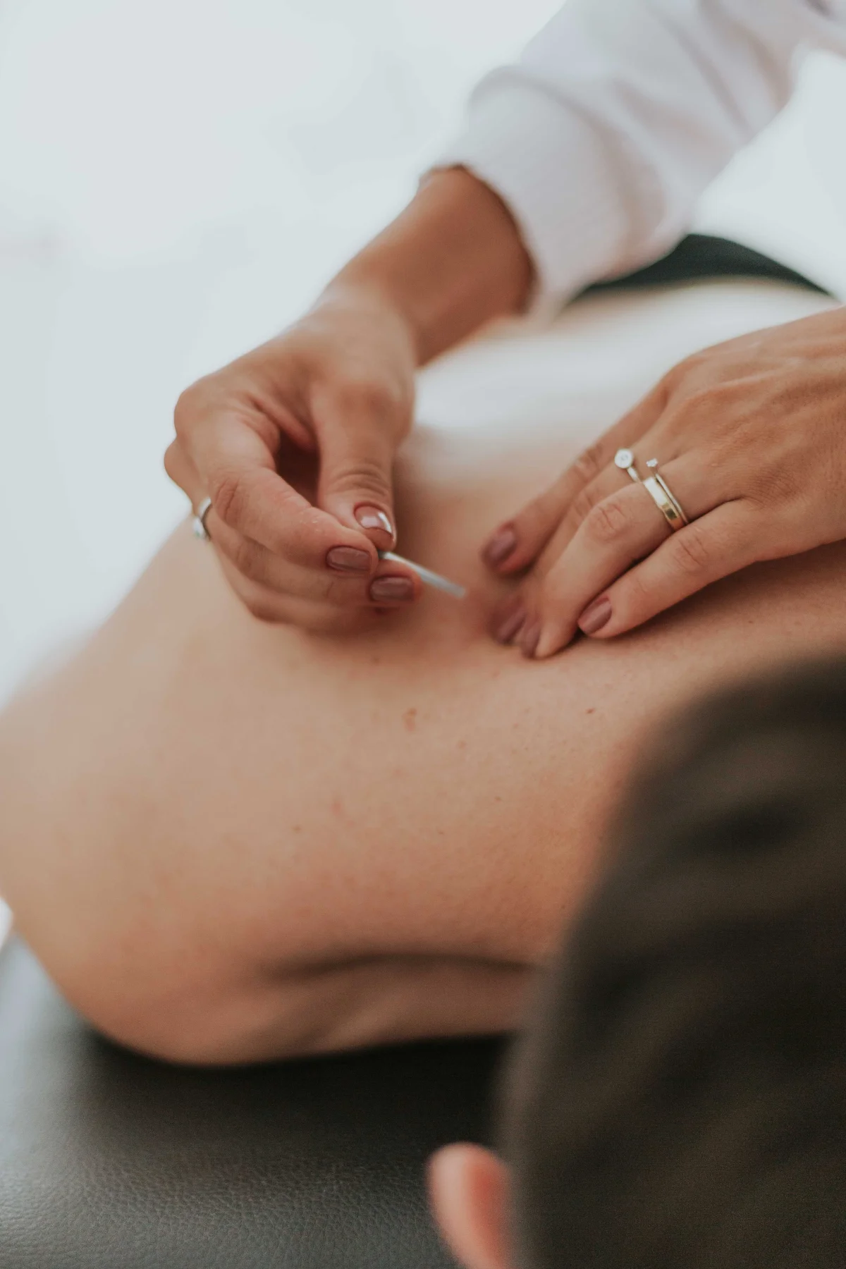 Benefits of Acupuncture