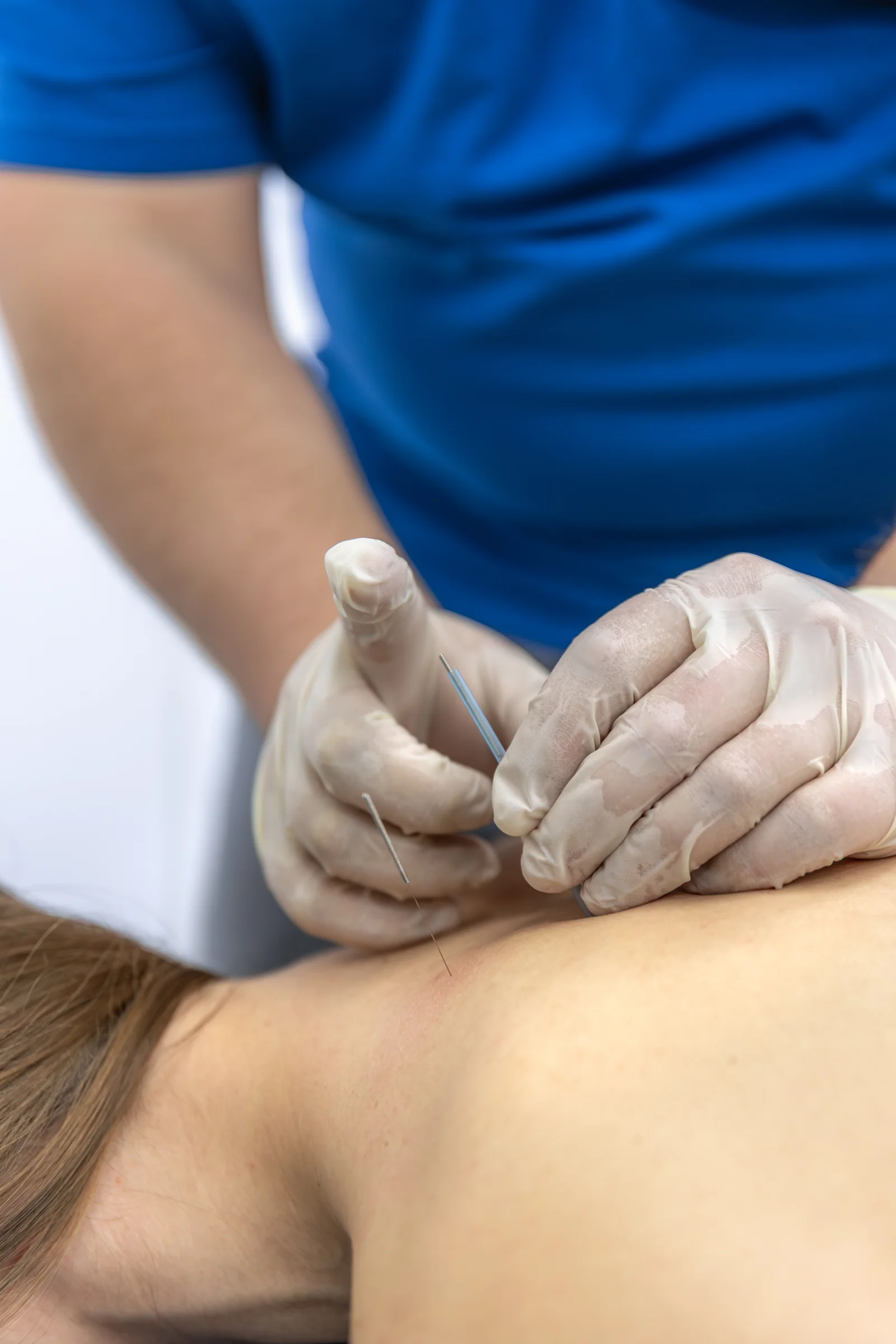 Acupuncture Treatment